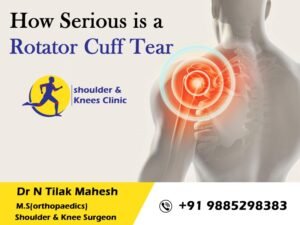 Read more about the article How severe is a rotator cuff tear?