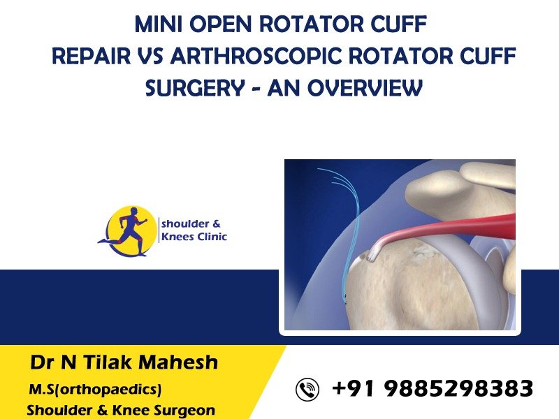Read more about the article Mini open rotator cuff repair vs Arthroscopic rotator cuff surgery – An Overview
